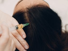 استخدام الميزوثيرابي لتساقط الشعر