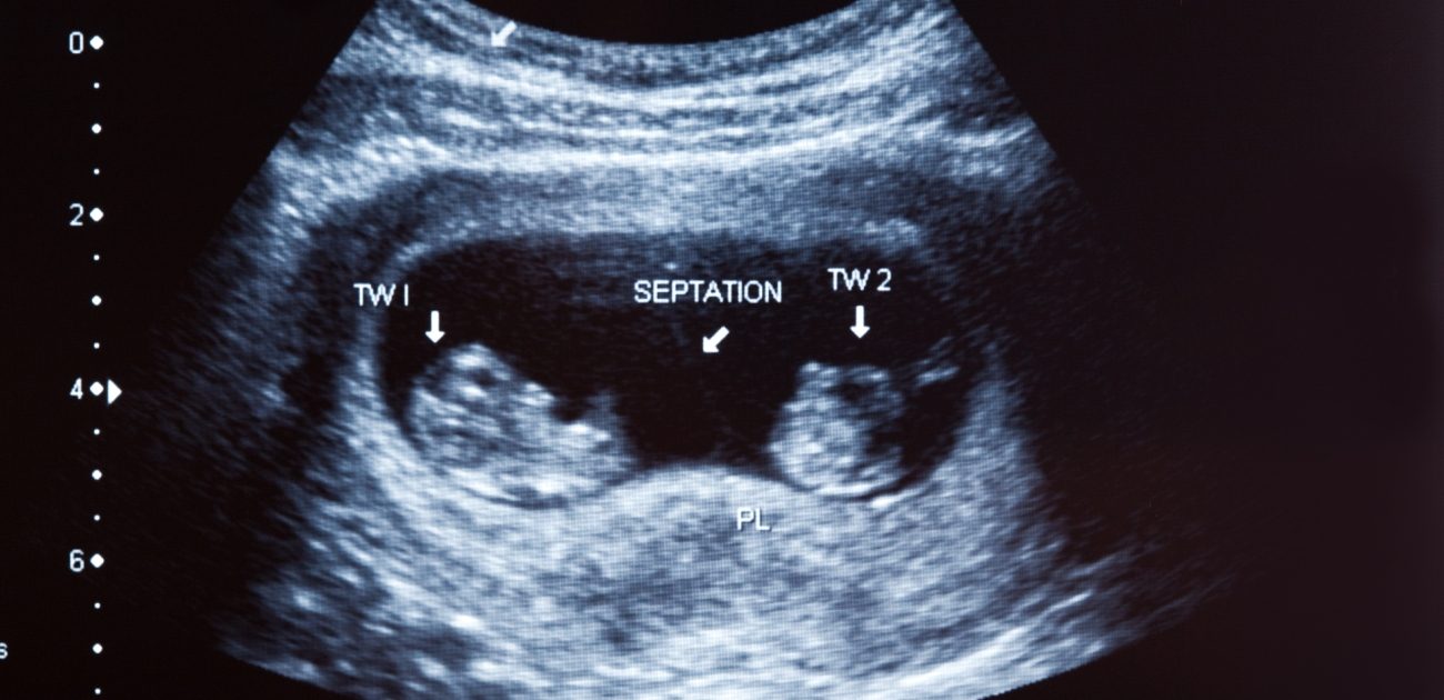 صورة بالموجات فوق الصوتية للتوأم