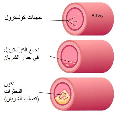 تصلب الشرايين: تعريف وأسباب