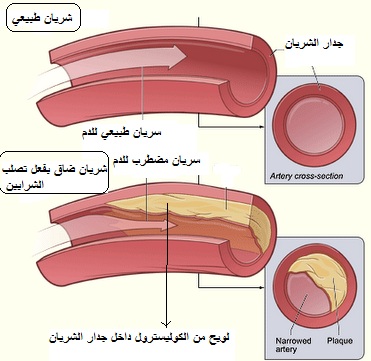تصلب الشرايين: الأعراض والتشخيص