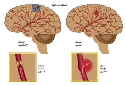 السكتة الدماغية: ماهيتها أسبابها وأعراضها