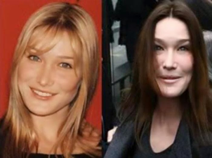 صور صادمة لنجمات شوّهت عمليات التجميل جمالهن