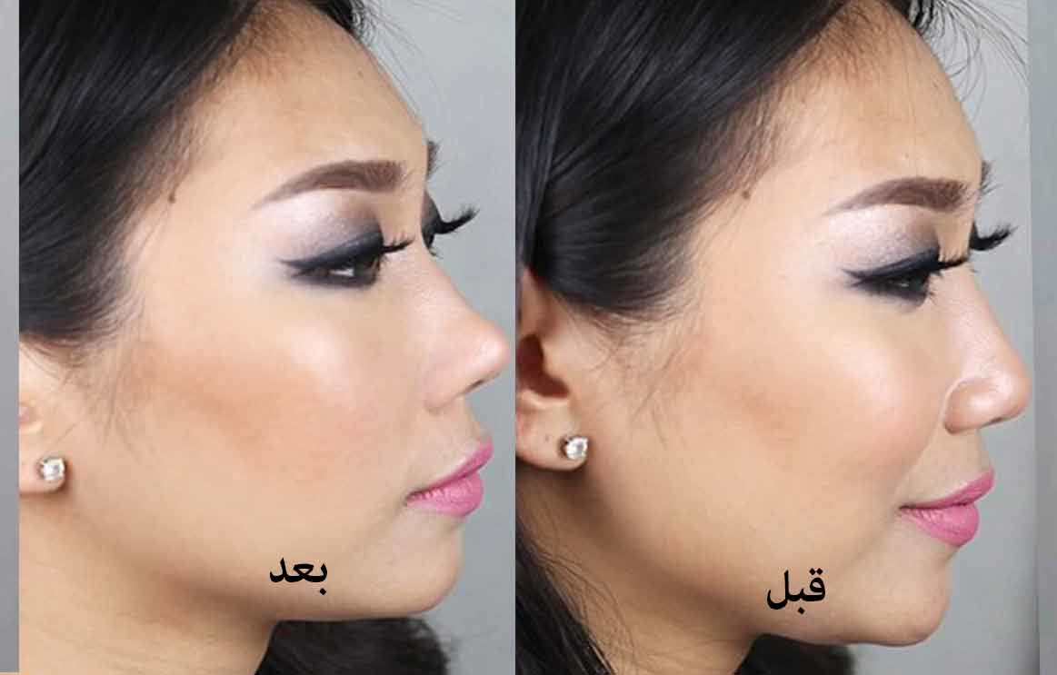 تقنية لرفع الأنف من دون عملية جراحية