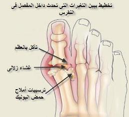 داء النقرس: تعريف وأسباب