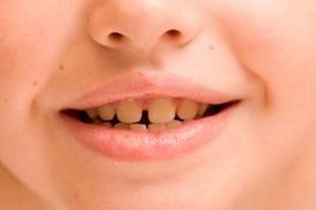 اصفرار اسنان الاطفال