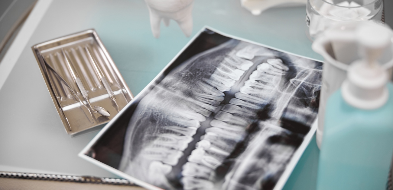 صورة X Ray للفكين